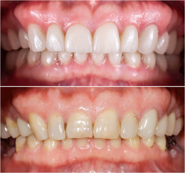Teeth Whitening at Fletcher Dental Centre