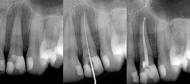 Root Canals at Fletcher Dental Centre
